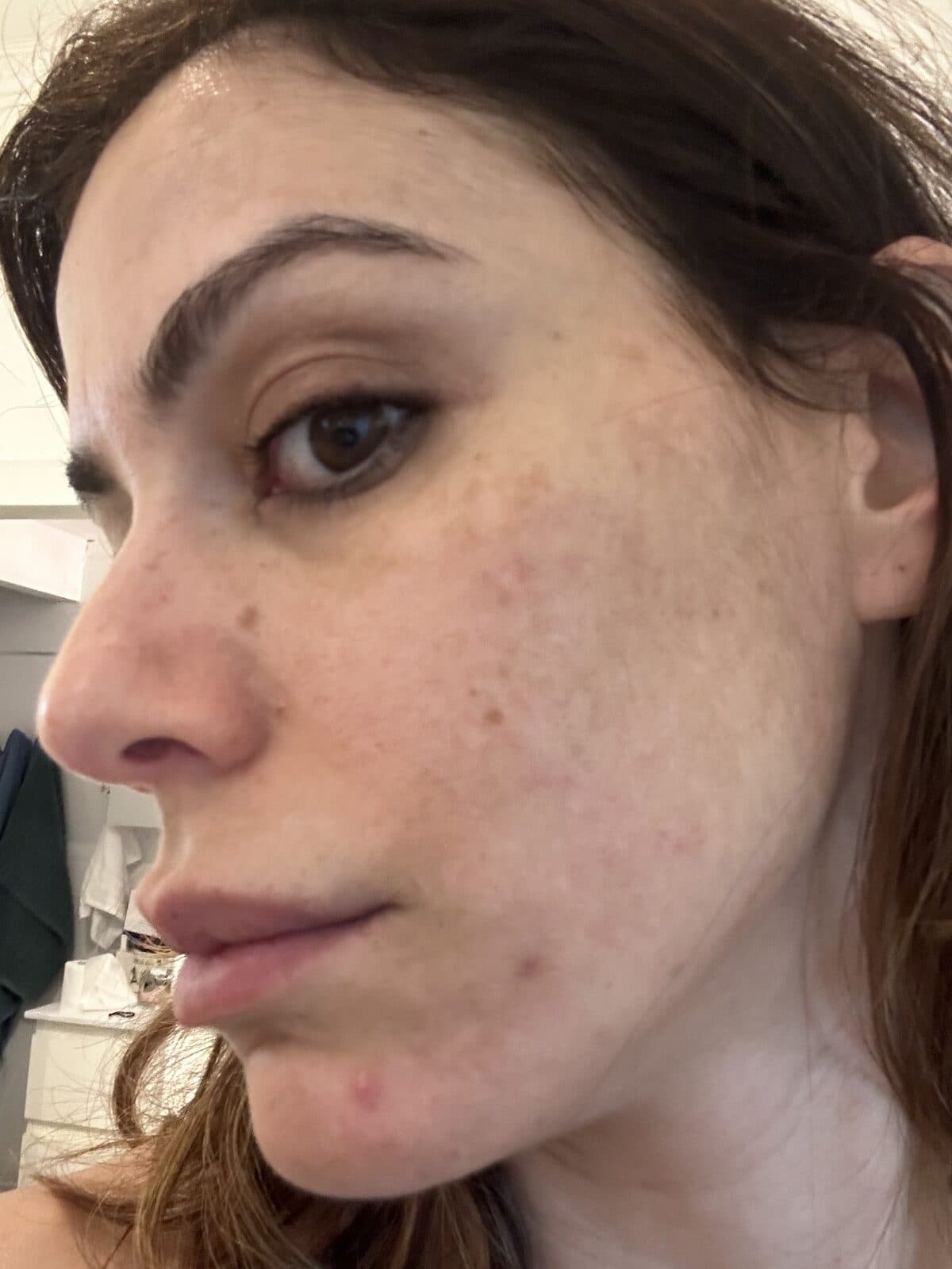 Cheek and jaw showing redness