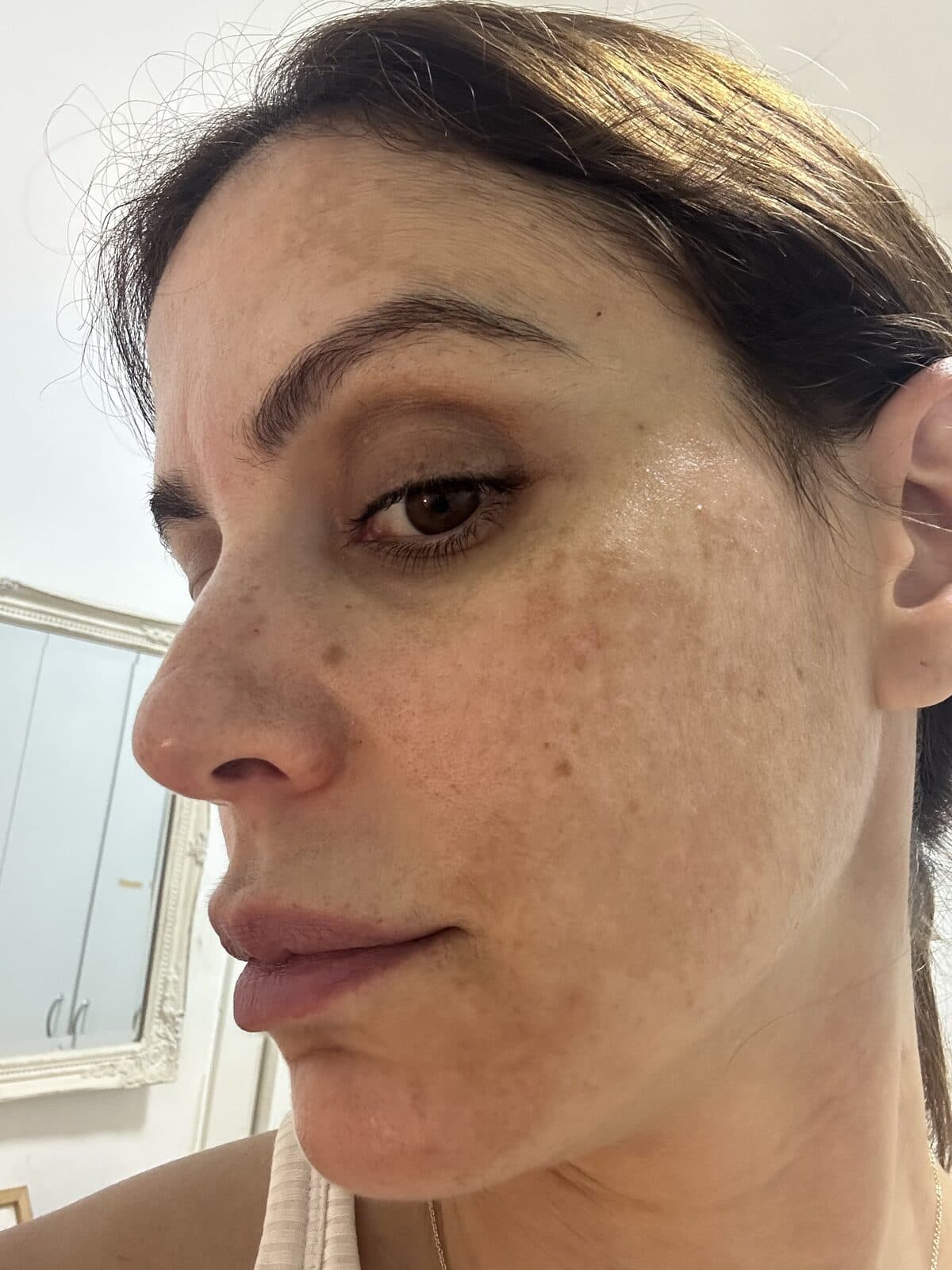Right cheek showing dense pigmentation pattern